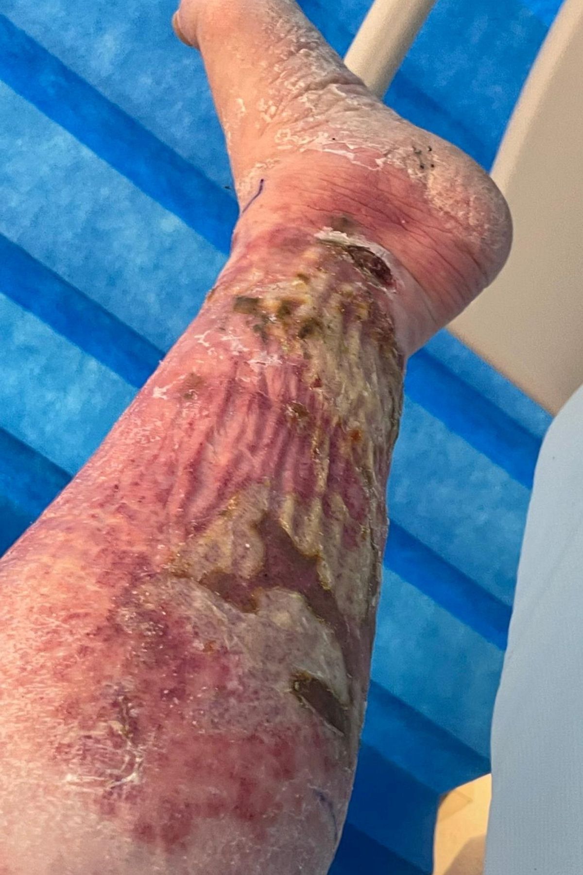 Glenn's leg ballooned after the bite